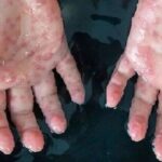 آبله میمون1